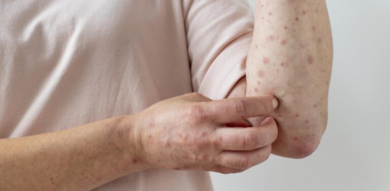 alergia-cutanea-no-braco-de-uma-pessoa